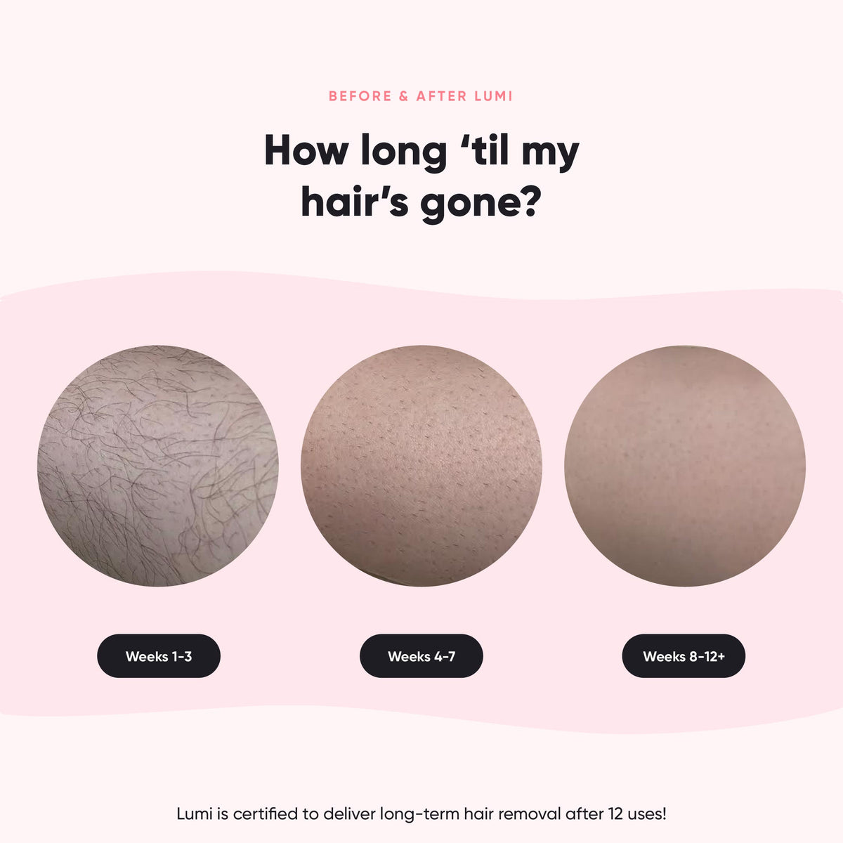 Lumi Permanent Hair Removal Device RoseSkinCo.